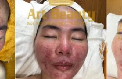 Điều trị thành công da bị nhiễm Corticoid cho chị Vân Anh